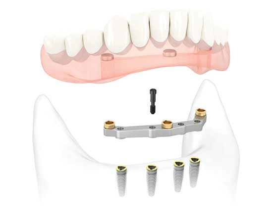 Implant Bar Supported Denture
