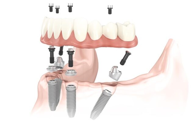implant denture 3D illustration