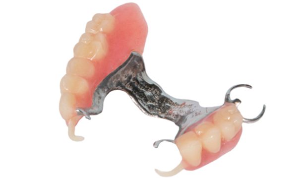 hybrid cast partial denture
