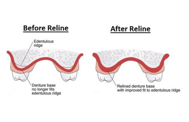 before and after graphic of denture relines