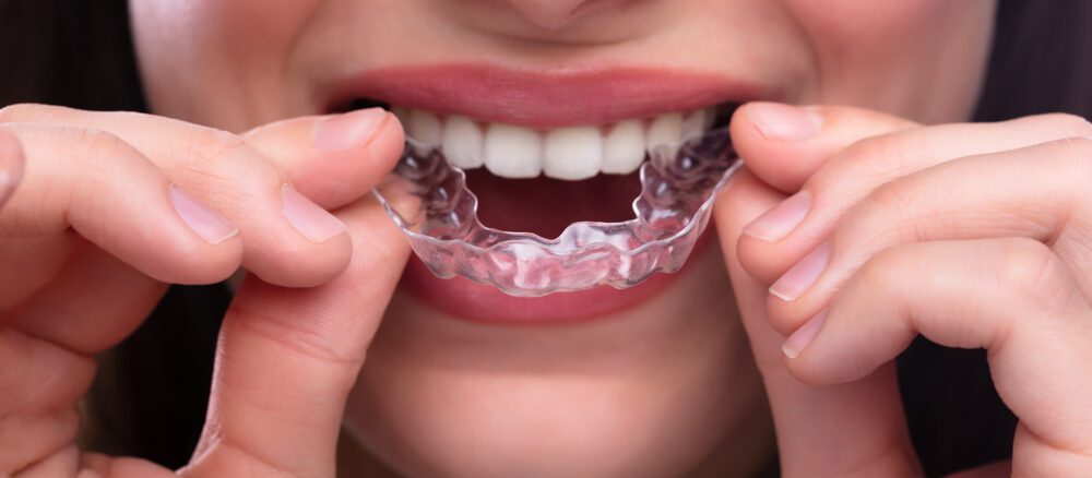 A woman putting a clear mouthguard into her mouth
